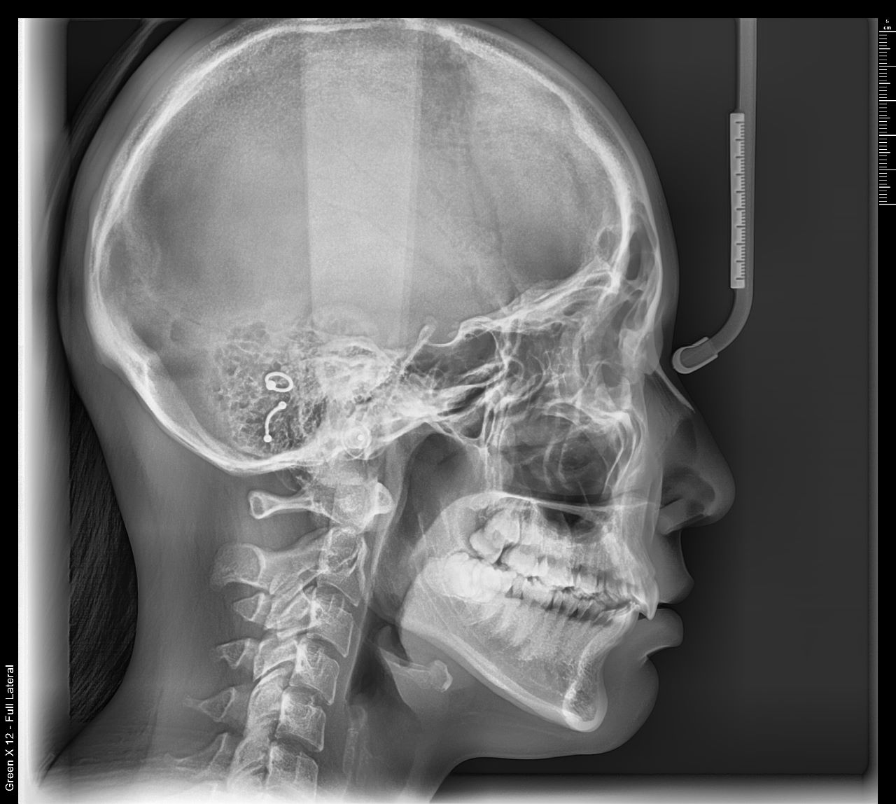 Tomógrafo Dental Vatech Green X12 - Radiografía Lateral de Cráneo
